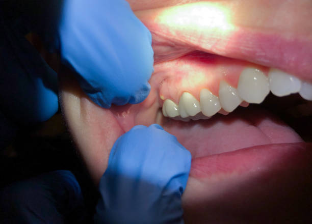 Best Emergency Treatment for Toothache in Columbia, SC